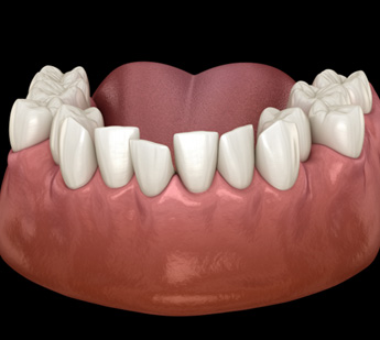 Illustration of crowded teeth