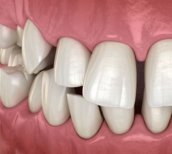 Illustration of gapped teeth