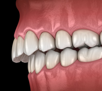 Illustration of an overbite