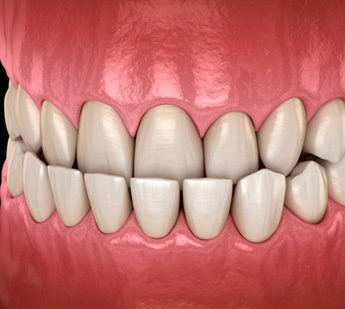 Illustration of an underbite