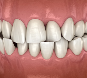 Illustration of a crossbite