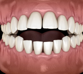 Illustration of an open bite