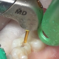 dental treatment on a tooth